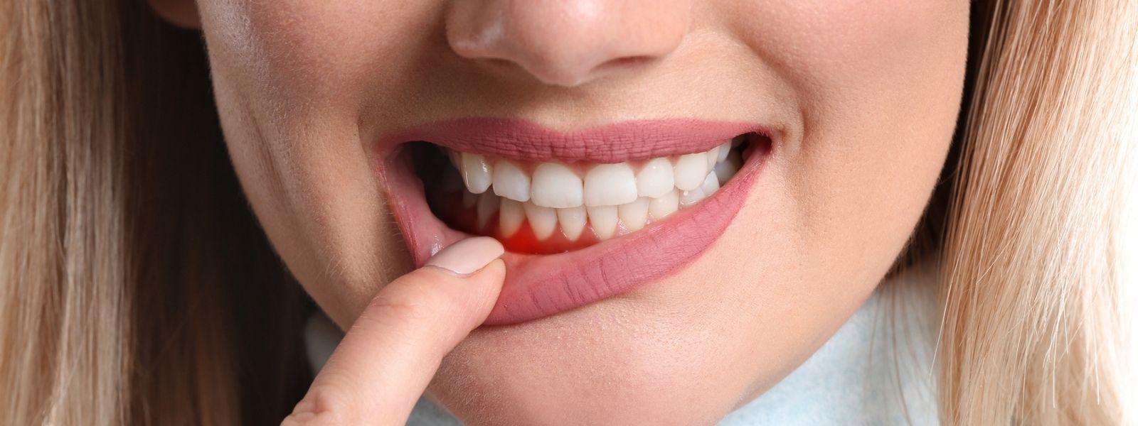 Gum grafting
