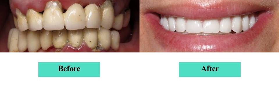 All-on X Implant Dentures Case 1