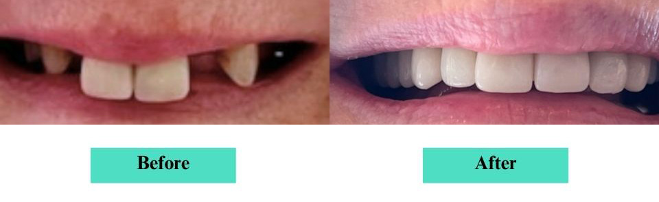 All-on X Implant Dentures Case 2