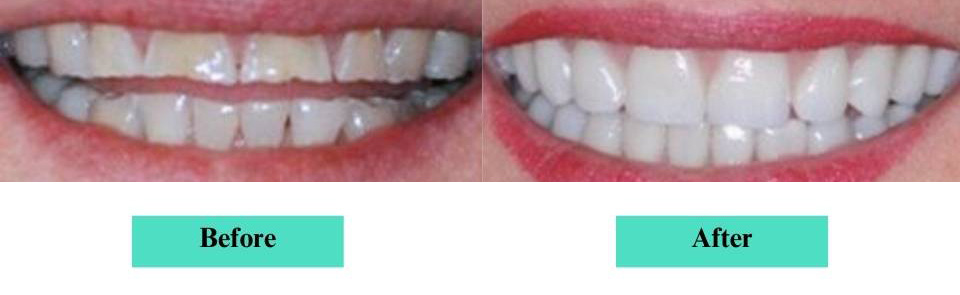 Cosmetic Veneers and Crowns Case (1)