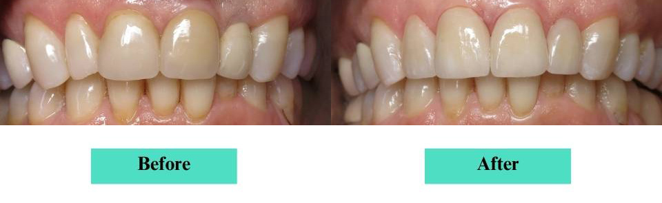 Cosmetic Veneers and Crowns Case (2)