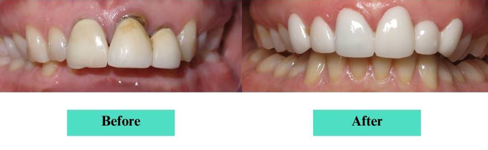 Cosmetic Veneers and Crowns Case (3)