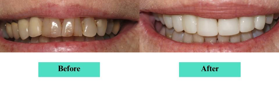 Cosmetic Veneers and Crowns Case (4)