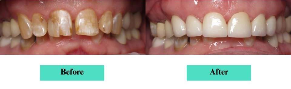 Cosmetic Veneers and Crowns Case (5)
