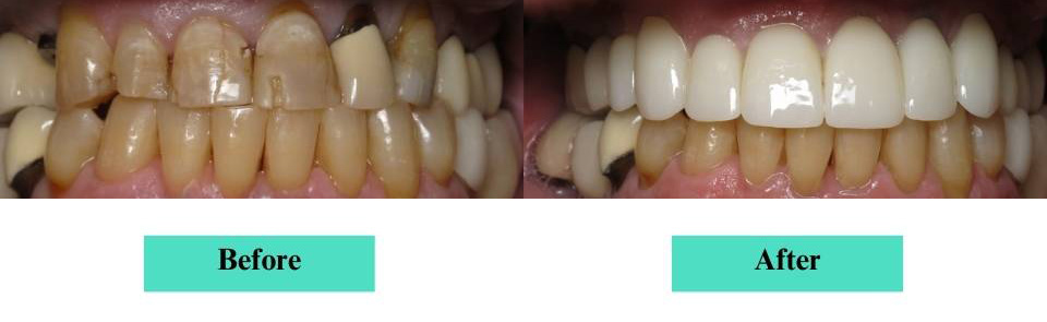 Cosmetic Veneers and Crowns Case (6)
