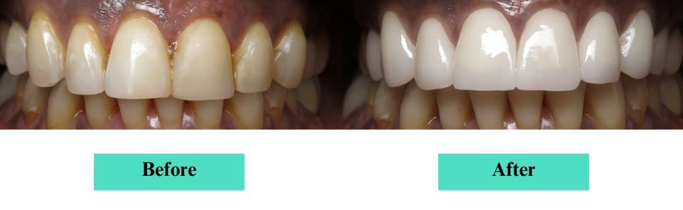 Cosmetic Veneers and Crowns Case (7)