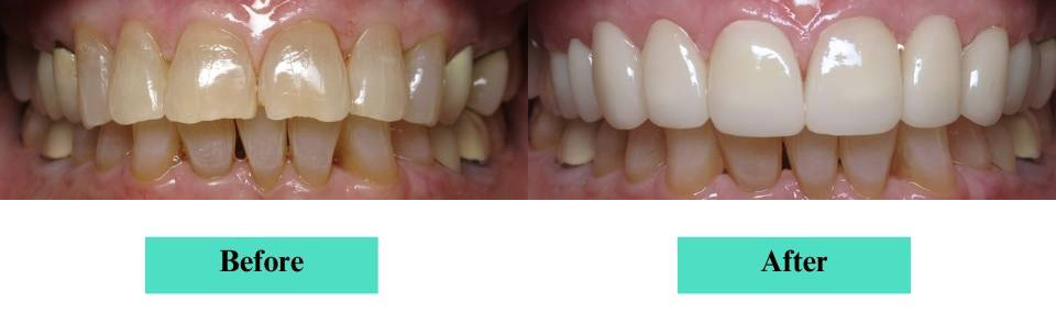 Cosmetic Veneers and Crowns Case (8)