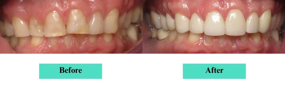 Smile Makeover Case (1)