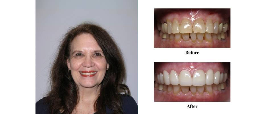 Smile Makeover Case (5)