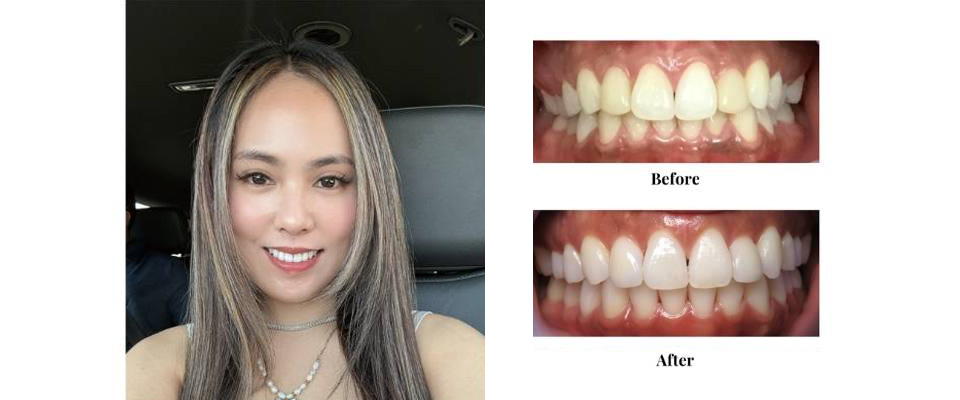 Smile Makeover Case (7)