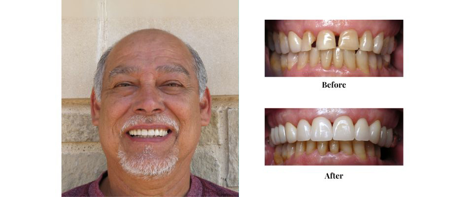 Smile Makeover Case (8)