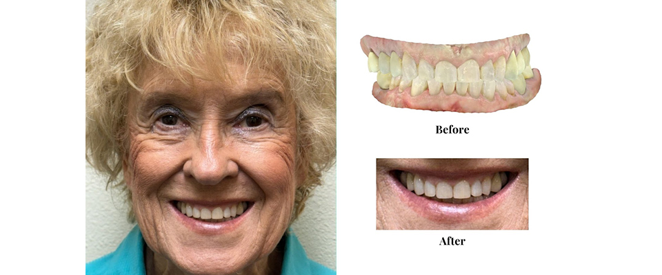 Smile Makeover Case 10