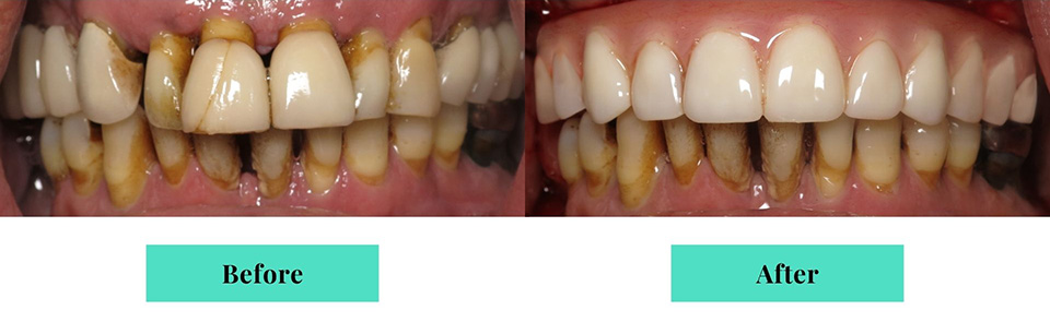 All-on X Implant Dentures Before & After Case 3