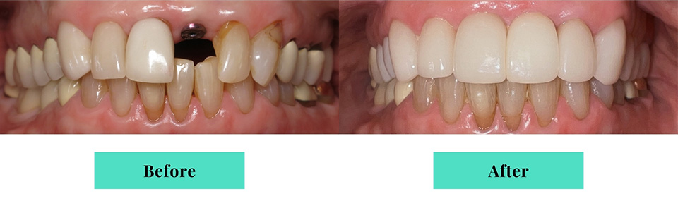 Anterior Implant Crowns Before & After Results, Case 3