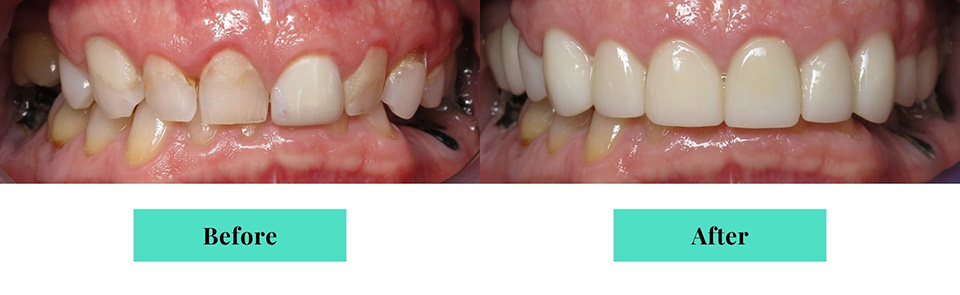 Full Arch Porcelain Crowns Before & After Results, Case 1