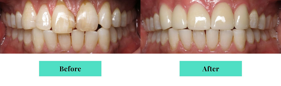 Maxillary Anterior Porcelain Crowns Before & After Results, Case 2