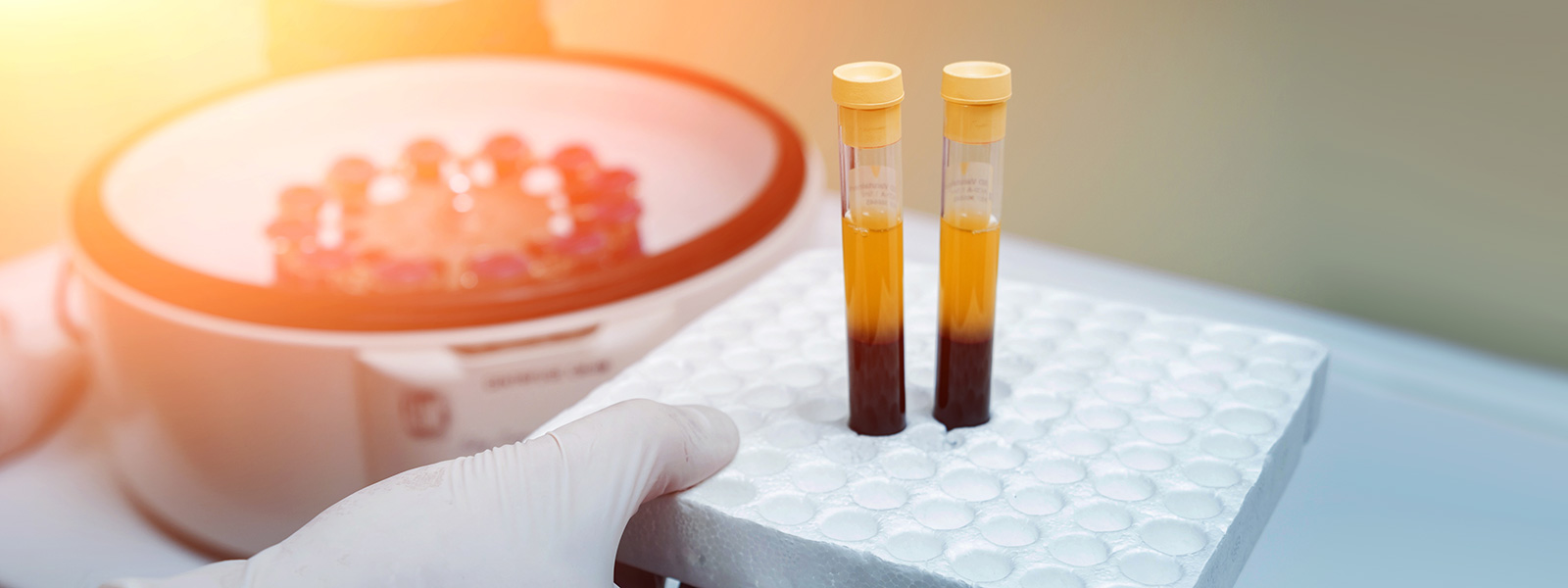 Platelet-Rich Fibrin (PRF) Murphy TX