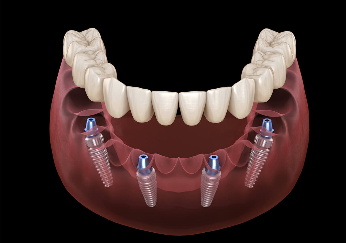 All on 4 Teeth Implants in Murphy TX Area