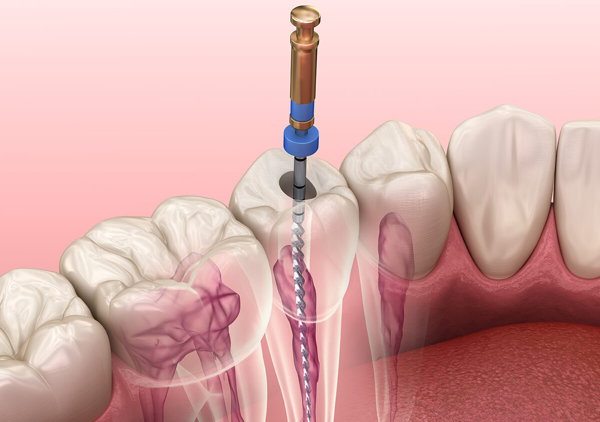Dental Root Canal Procedure in Murphy TX Area