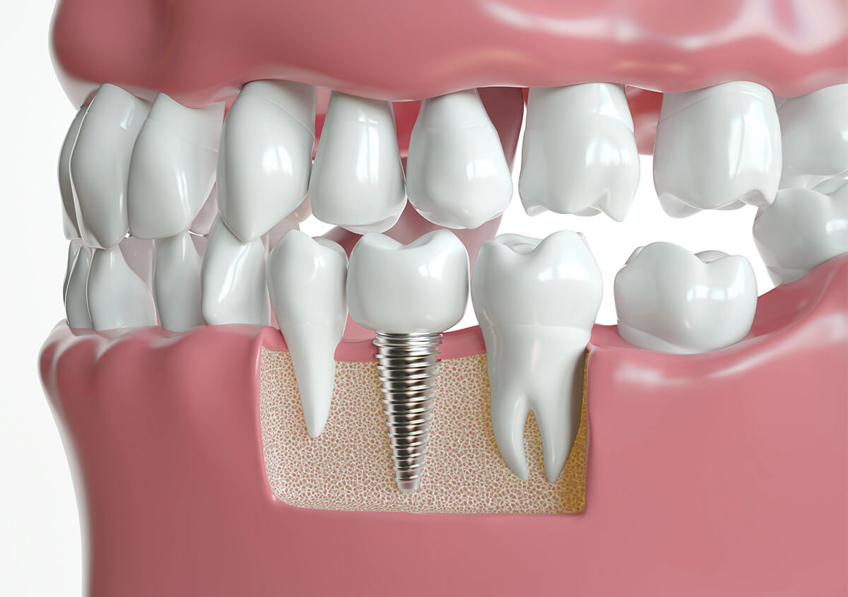 Good Dental Implants in Murphy TX Area