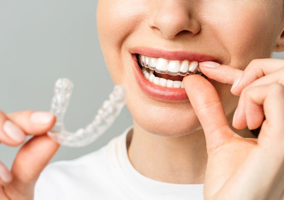Invisalign Teeth Straightening in Murphy TX